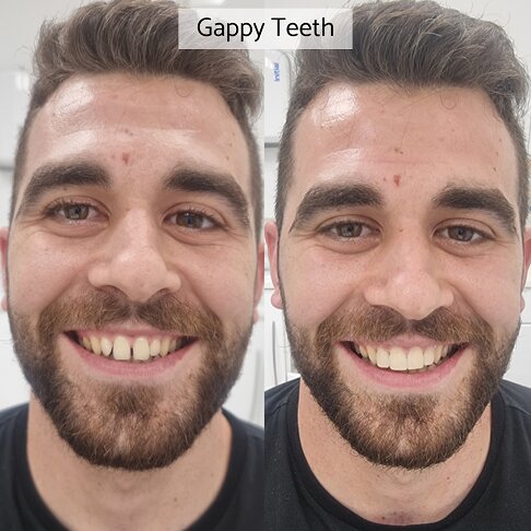 Male patient showing his before after picture of closing gaps in her teeth with Invisalign braces