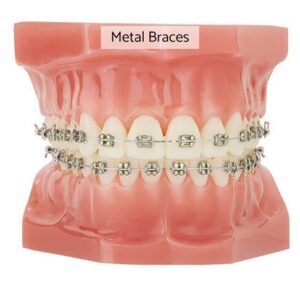 Metal braces cost in London