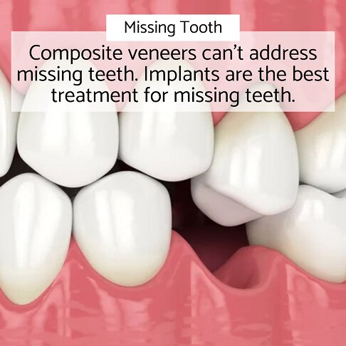 Missing teeth cannot be fixed with composite veneers