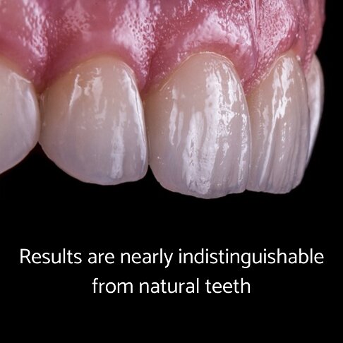 Our results with layered composite bonding are almost indistinguishable from natural teeth