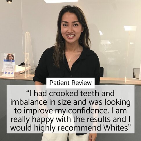 Patient review for composite veneers in London Waterloo