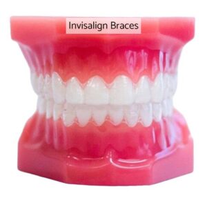 Photo of Invisalign braces