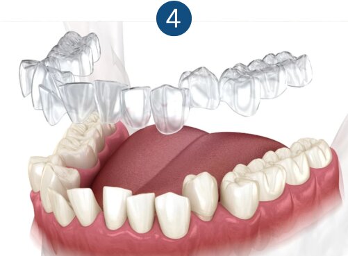 Receive your first set of Invisalign aligners