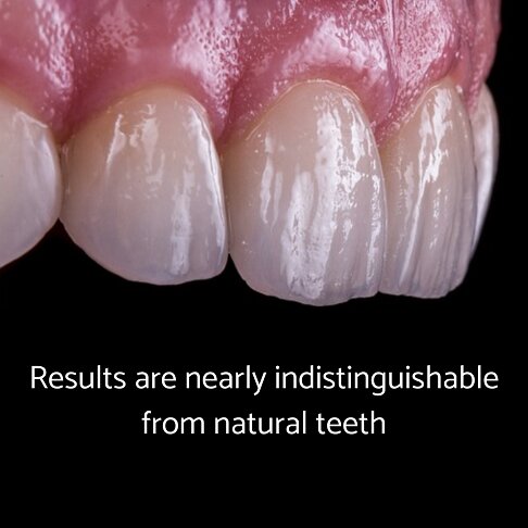 Results with layering technique for composite bonding are nearly indistinguishable from natural teeth