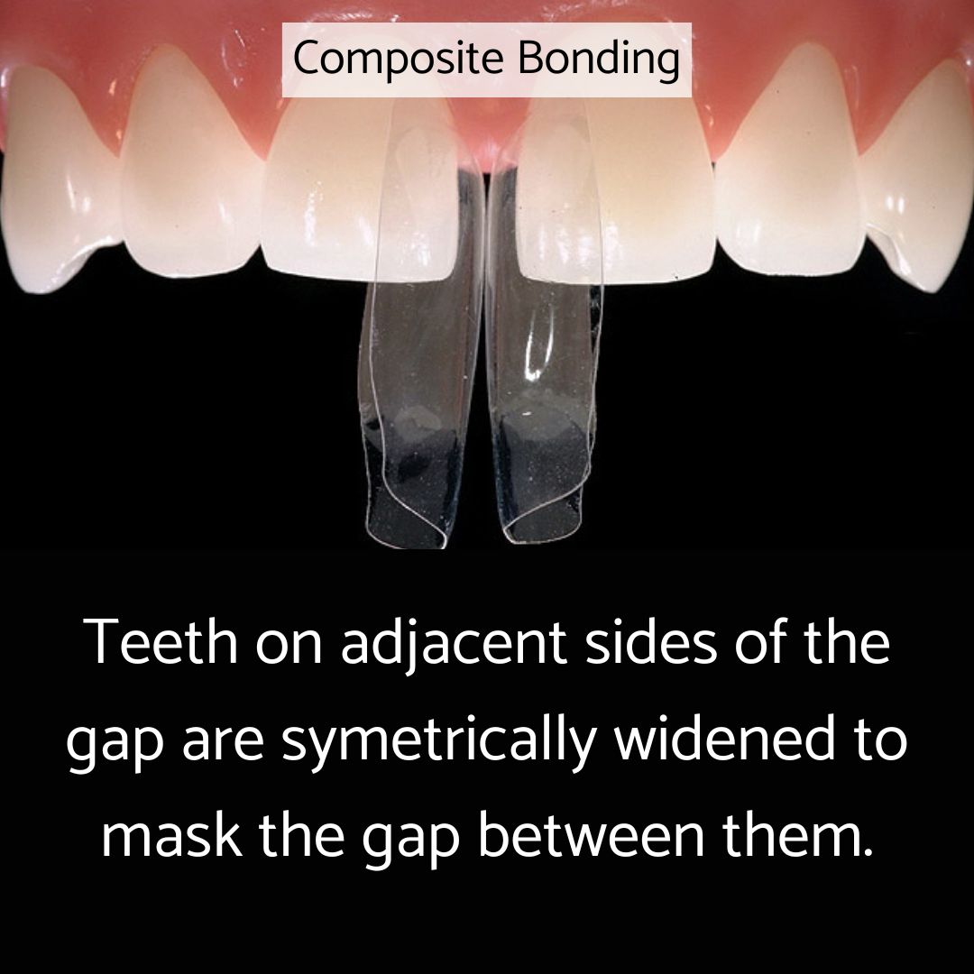 Teeth on adjacent sides of the gap are symetrically widened with composite bonding to mask the gap between them