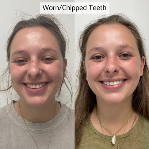 Veneers Cost London - Before And After - Worn Out Chipped Teeth