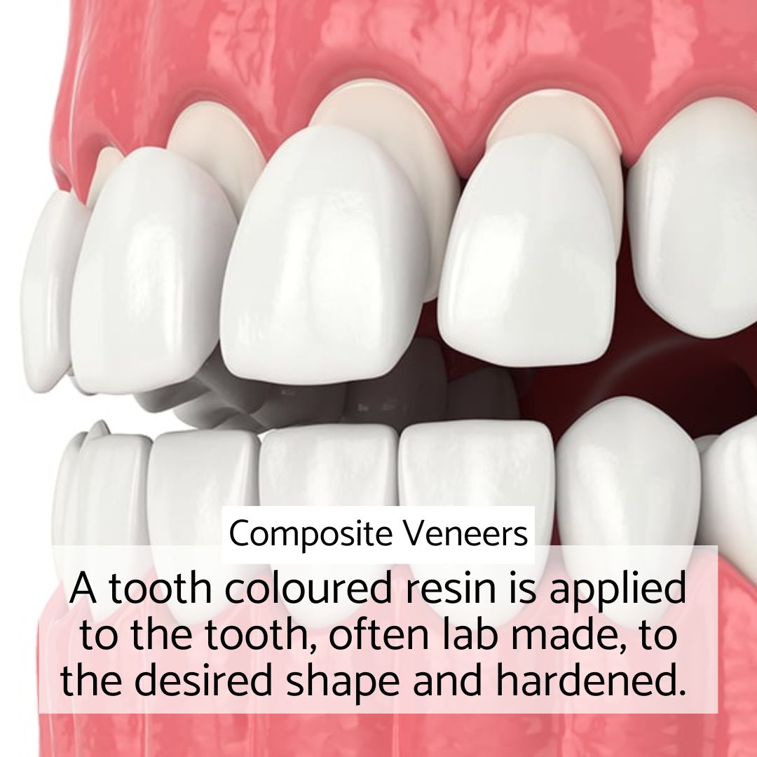 What are composite veneers