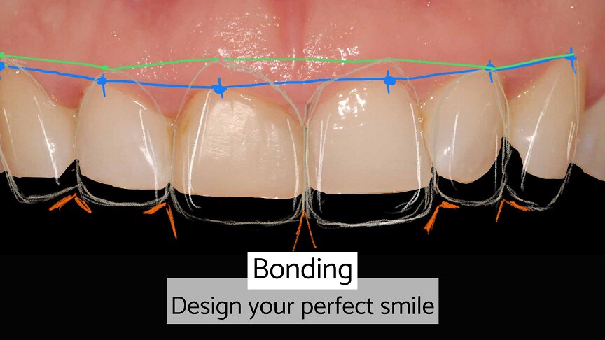 What is composite bonding