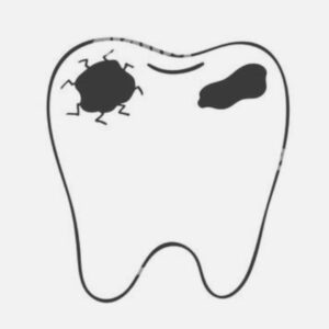 White Filling dental treatment