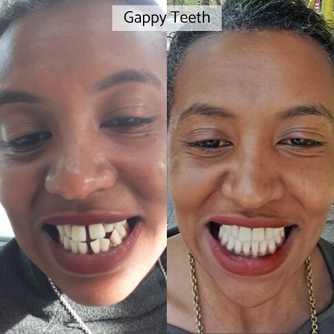 Woman patient showing her before after picture of closing gaps in her teeth with Invisalign braces