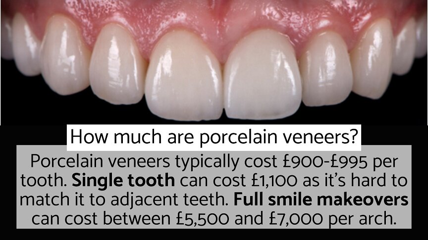 how much are porcelain veneers